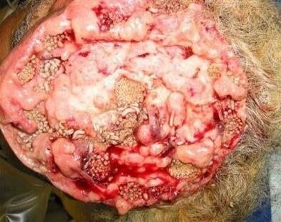 Παράσιτα στον ανθρώπινο εγκέφαλο